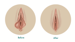 Vagina tightening
